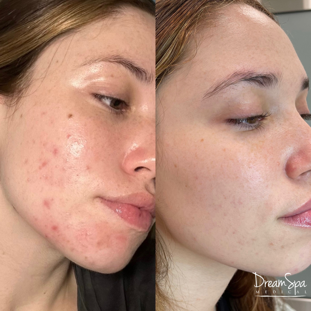 Acne Clinic 3 Dream Spa Medical how-to-use-bullets-and-edit-a-list-in-microsoft-word-2010-youtube