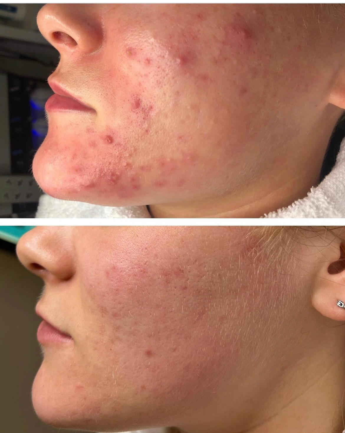 Acne Clinic 4 Dream Spa Medical acne-clinic-4-dream-spa-medical