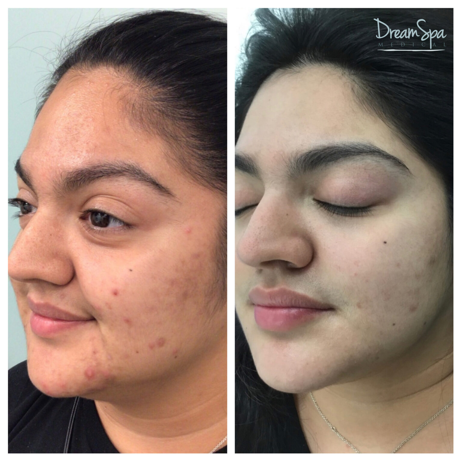 Acne Clinic 7 Dream Spa Medical acne-clinic-7-dream-spa-medical