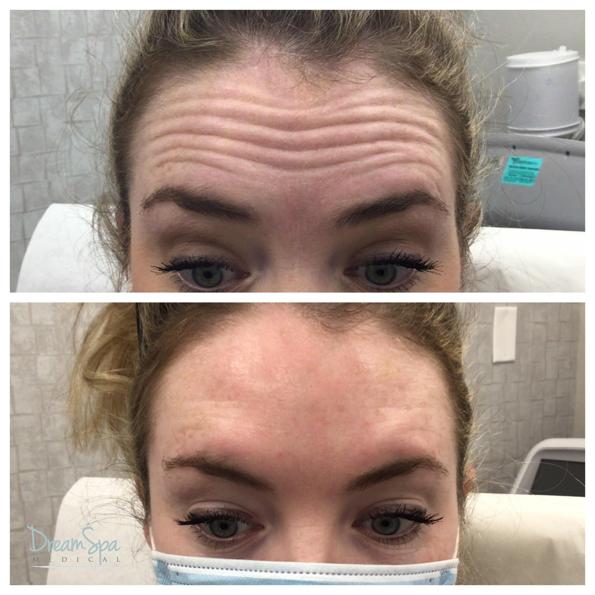 What to Expect at Your First Botox Appointment - Dream Spa Medical - Blog