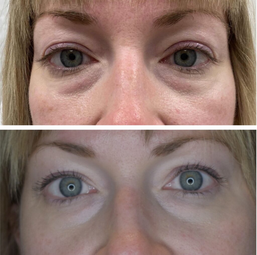 PRP Under-Eye Treatment