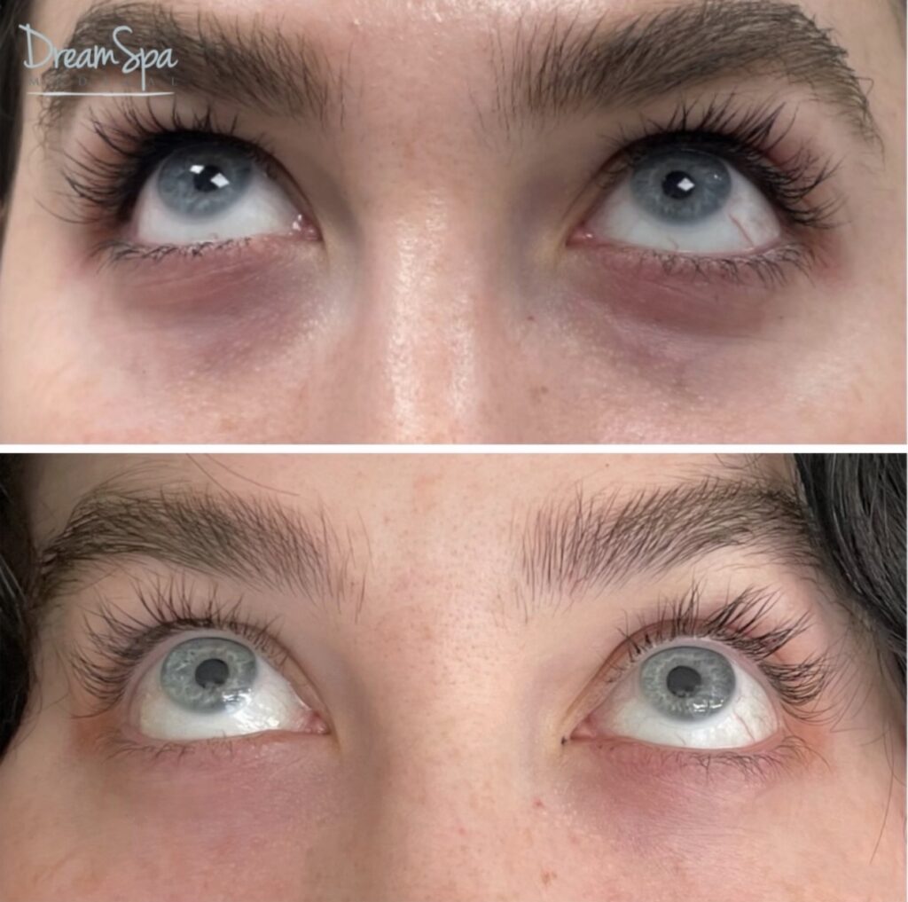 PRP Under-Eye