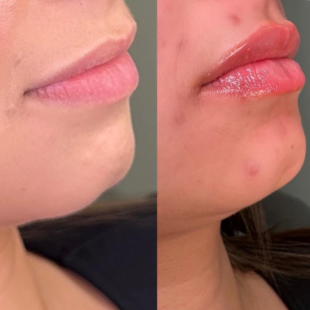 Lip Filler Before and After